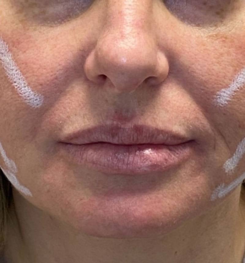 imgi_2_800px_patient2-before-pdo-threadlift-2 imgi_2_800px_patient2-before-pdo-threadlift-2