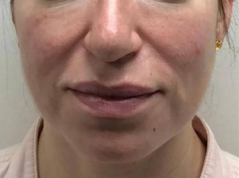 imgi_4_800px_patient1-before-pdo-threadlift-2 imgi_4_800px_patient1-before-pdo-threadlift-2