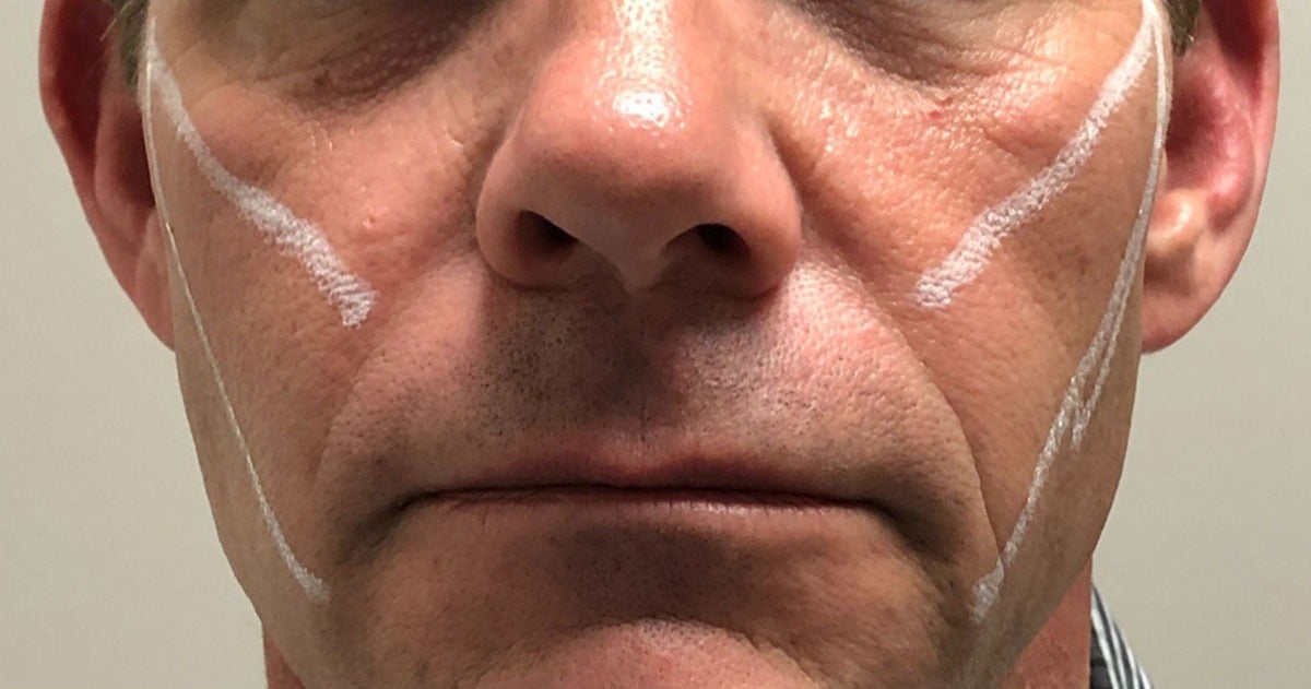 imgi_6_1200px_patient3-before-pdo-threadlift-2 imgi_6_1200px_patient3-before-pdo-threadlift-2