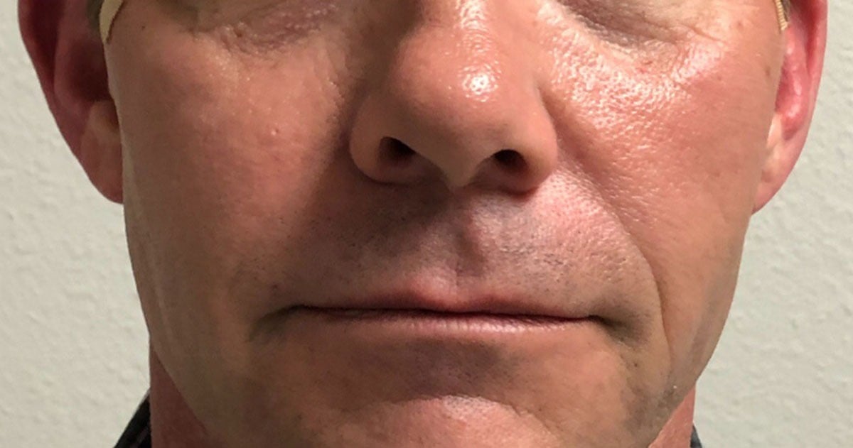 imgi_7_1200px_patient3-after-pdo-threadlift-2
